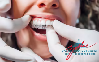 putting clear aligners on