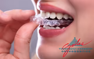 woman putting clear aligner on