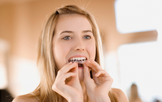 Invisalign for Teens